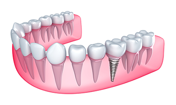 Dental Implants | Dentist In Honeoye Falls, NY | HFL Dental