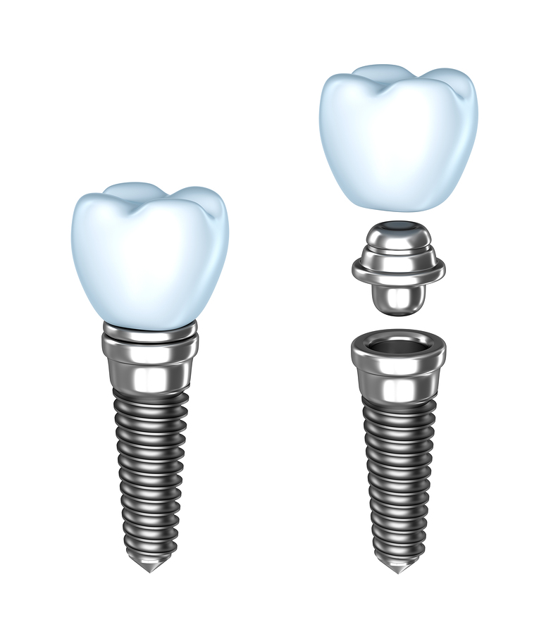 Dental Implants - Mendon, NY